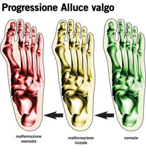 alluce valgo